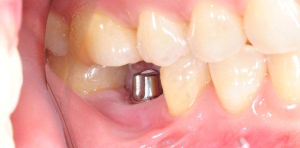 Reasons-why-Dental-implants-are-so-important